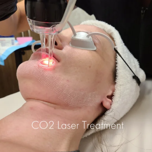 What are the Benefits of CO2 Laser Resurfacing?